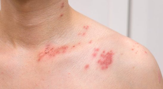 Shingles photo contagion causes according to this dermatologist