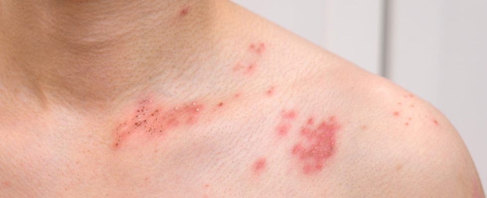 Shingles photo contagion causes according to this dermatologist