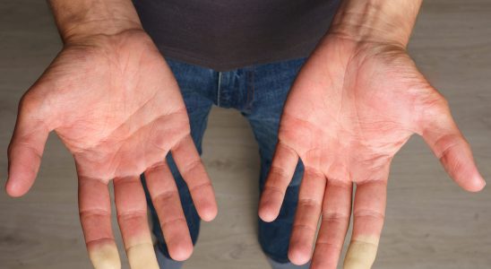 White fingertips Raynauds Syndrome