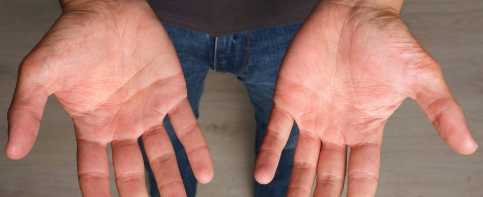 White fingertips Raynauds Syndrome