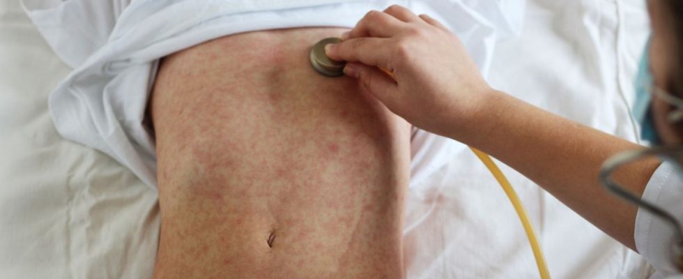 Worrying resurgence of measles in Europe is France concerned