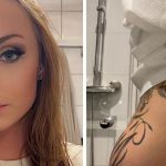 Amanda 26 suffered nerve damage after butt augmentation