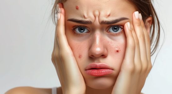 What alcohols cause pimples