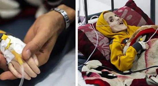 20 children dead from starvation in Gaza