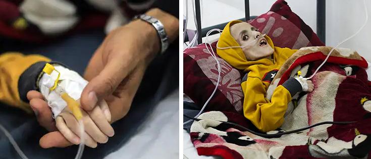 20 children dead from starvation in Gaza