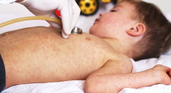 A start of an epidemic of measles is raging in