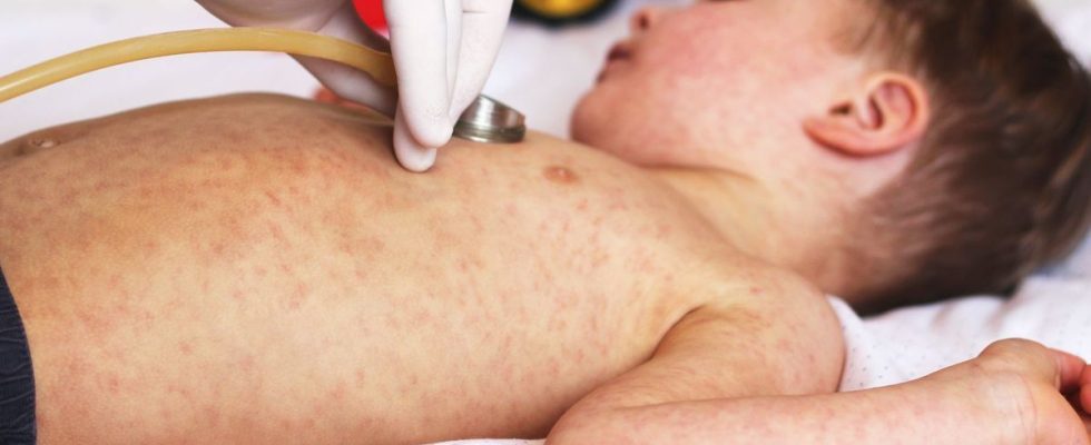 A start of an epidemic of measles is raging in