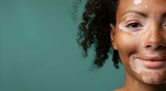 A study reveals finally how young people perceive their vitiligo