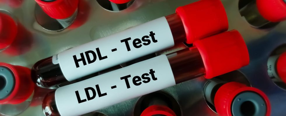 LDL cholesterol low calculation in women what standard