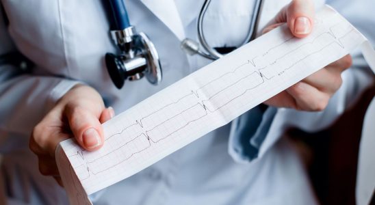 Screening for atrial fibrillation directly with your GP could reduce