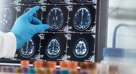 Stroke Alzheimers… The worrying progression of neurological pathologies – LExpress