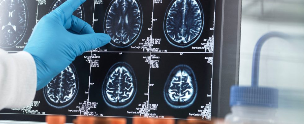 Stroke Alzheimers… The worrying progression of neurological pathologies – LExpress