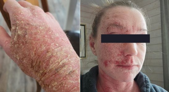 This is how Linda 39 lives with severe rashes
