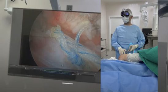 Apple Vision Pro was used in a shoulder surgery this