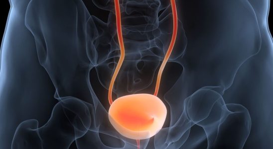 Bladder cancer an obvious symptom should lead you to consult