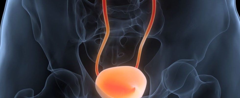 Bladder cancer an obvious symptom should lead you to consult