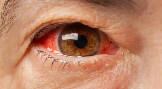 Contagious red eye disease raised alarm It is spreading rapidly