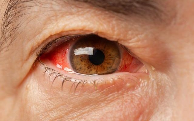 Contagious red eye disease raised alarm It is spreading rapidly