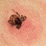 The first tick case of the year was seen Experts
