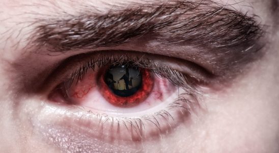 We finally know why you may have red eyes in