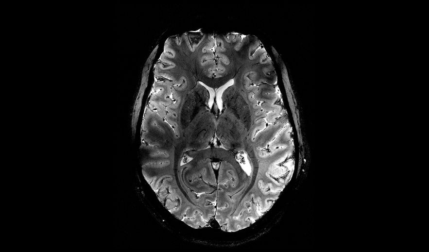 The first images of the brain with the Iseult MRI