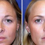 A study on twins reveals the true effects of botox