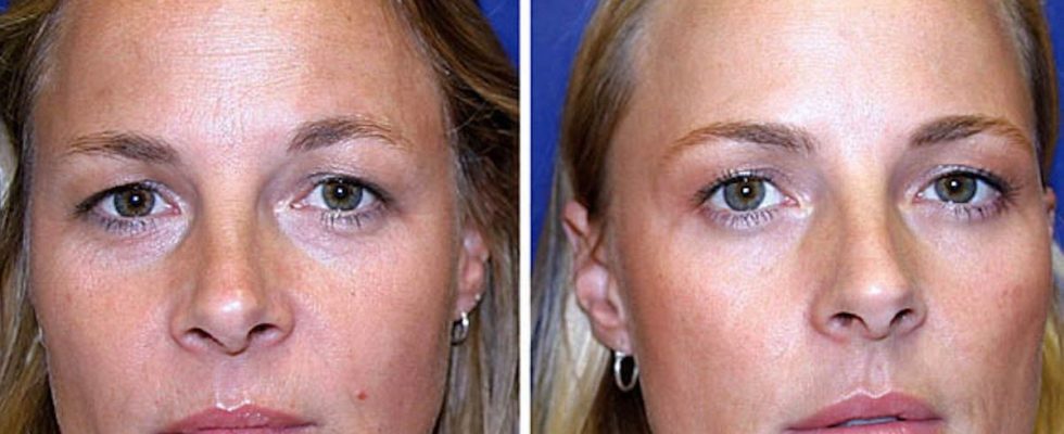 A study on twins reveals the true effects of botox