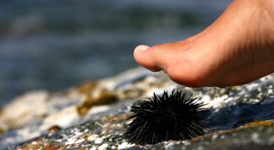 After stepping on a sea urchin he had 3 toes