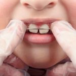 Orthodontics more than one in two French people still do