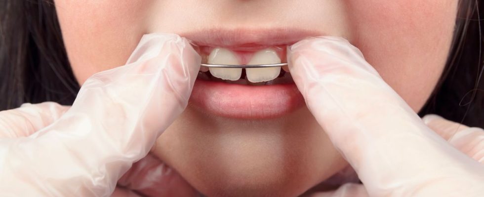 Orthodontics more than one in two French people still do