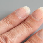 Striated nails this is not normal you need to consult