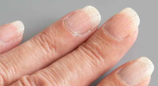 Striated nails this is not normal you need to consult