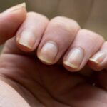 This abnormality on your nails could be a sign of