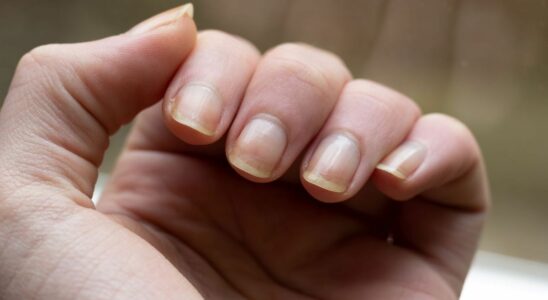 This abnormality on your nails could be a sign of