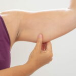 Too much fat in the arms bad for womens bones