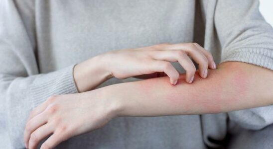 Frightening scabies alert Its on the rise again There has