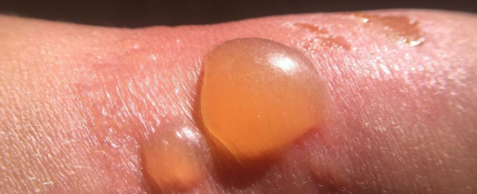 Giant blisters burns after getting wet with lake water what