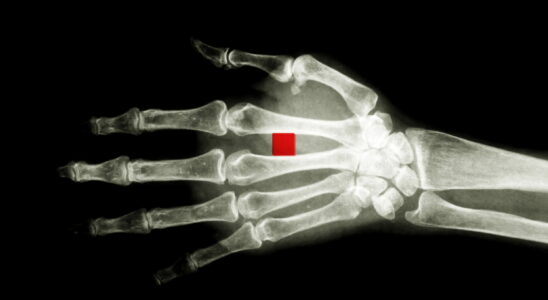 A cybersecurity expert has had a dozen microchips implanted in