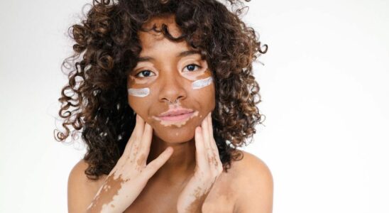 Vitiligo Revolutionary treatment reimbursed available in pharmacies from July 27