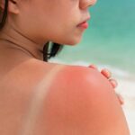 Be careful this type of sunburn increases the risk of