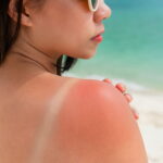 This is the most carcinogenic type of sunburn it increases