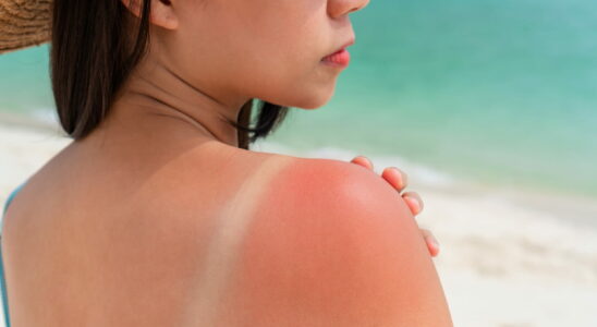 This is the most carcinogenic type of sunburn it increases