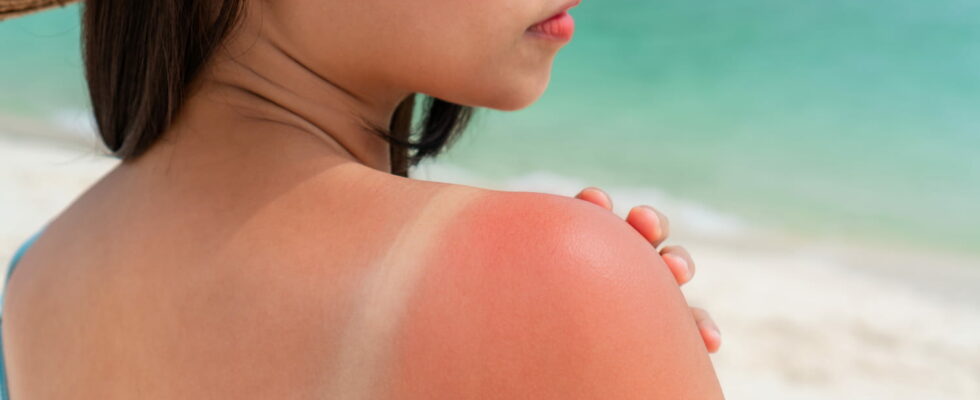 This is the most carcinogenic type of sunburn it increases