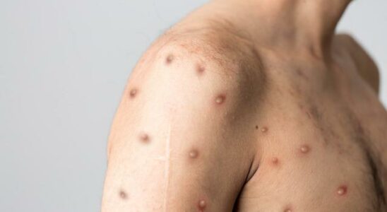 What is monkeypox what are its symptoms How is monkeypox