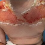 10 year old boy used sunscreen He was taken to hospital Its