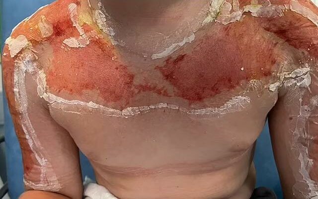 10 year old boy used sunscreen He was taken to hospital Its