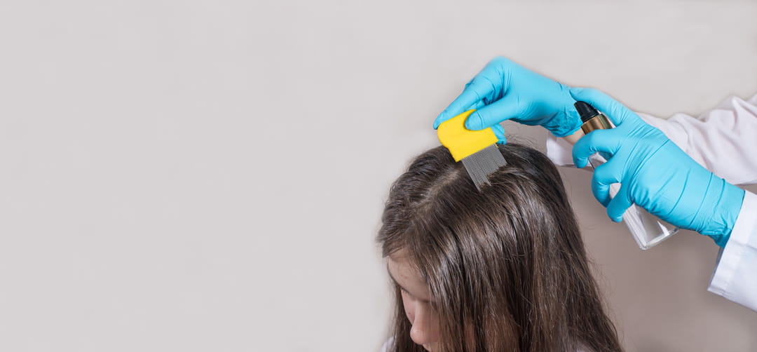 1727761435 895 Heres why lice prefer your childs head over everyone elses