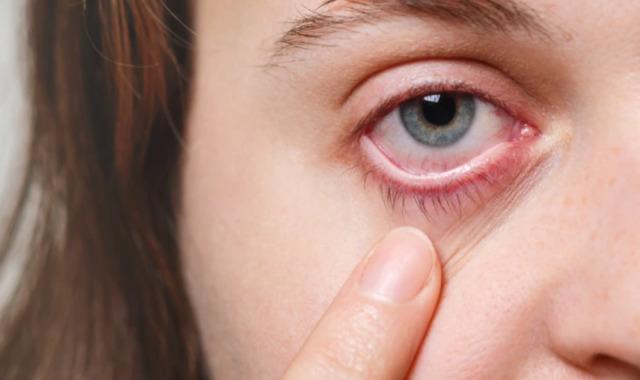 red eye disease