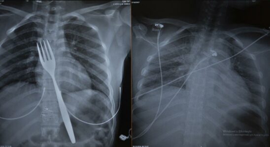 Extraordinary case in Aydin He swallowed an 18 centimeter fork doctors