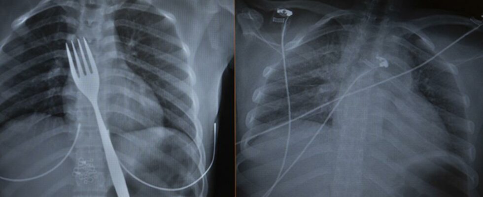 Extraordinary case in Aydin He swallowed an 18 centimeter fork doctors